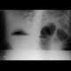 Carcinoma of colon, lienal flexure, large bowel ileus, lung metastasis: X-ray - Plain radiograph